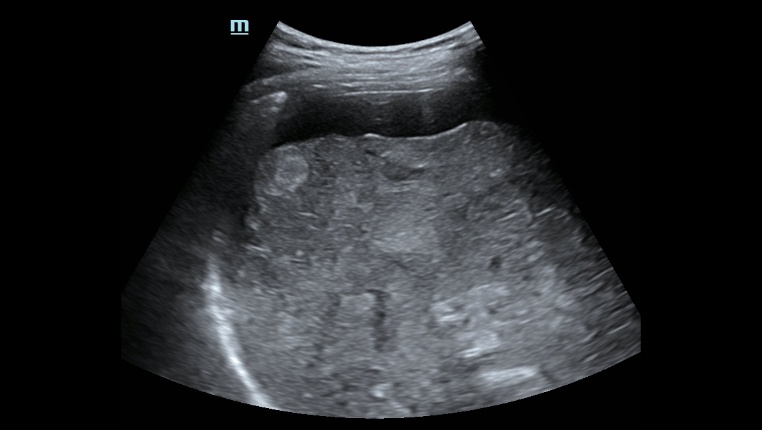 Mindray Hepatus 5 ультразвуковая система фибросканирования печени фото 5