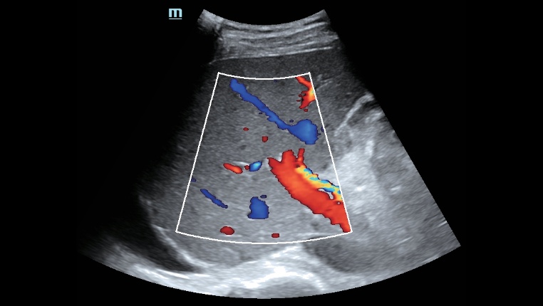 Mindray Hepatus 6 ультразвуковая система фибросканирования печени фото 10